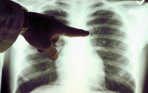 Tumore del polmone: la combinazione Nivolumab e Ipilimumab  efficace in prima linea nei pazienti con elevato carico mutazionale