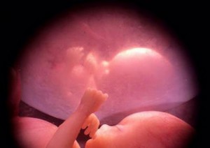 Trapianto d&#039;utero tra gemelle, bimbo è nato e sta bene