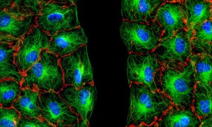 tumori - cellule fibroblasti