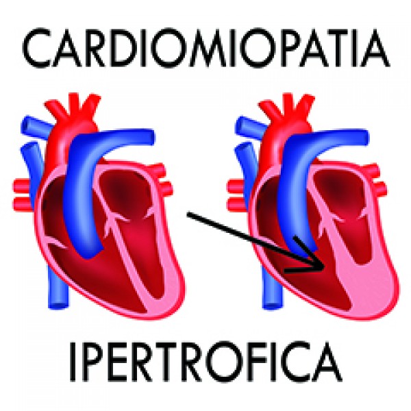 Cardiomiopatia ipertrofica ostruttiva: la commissione europea approva Mavacamten 