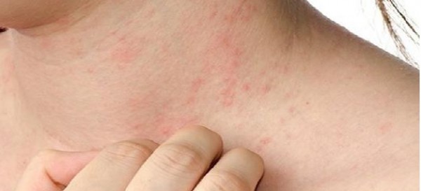 Morbillo, record di casi in Europa, il numero più alto di contagi dell&#039;ultimo decennio