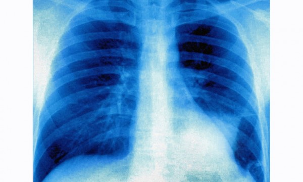 Passo avanti del Cnr per trattare il tumore al polmone