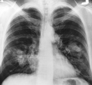 Tumore polmone: immunoterapia Roche porta a 13.8 mesi la sopravvivenza media dei pazienti con NSCLC