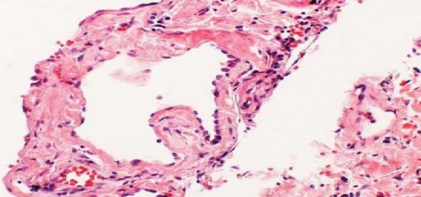 Particolare di amiloloidosi con fibrille amiloidi - Foto tratta da Benessereblog