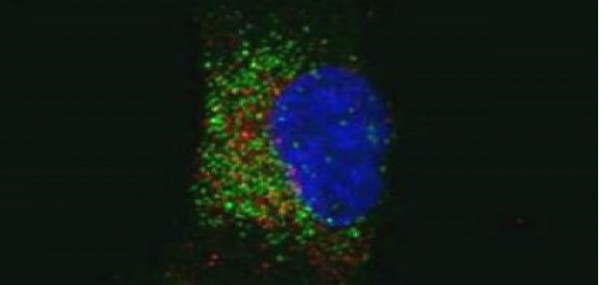 Una cellula tumorale portatrice della fusione genica Fgfr3-Tacc3 con marcata attivazione dei perossisomi, le piccole strutture in verde (Columbia University, New York)