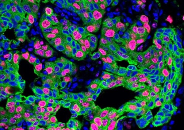 Lo stress fa sì che alcuni globuli bianchi chiamati neutrofili formino strutture appiccicose simili a reti