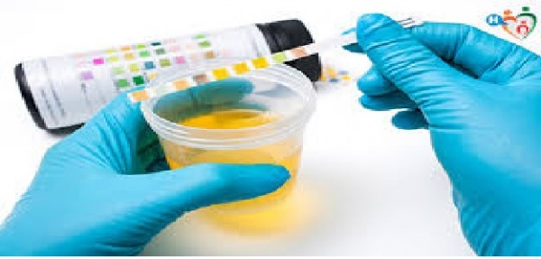 Cancro alla prostata: gli scienziati sviluppano un test delle urine a casa