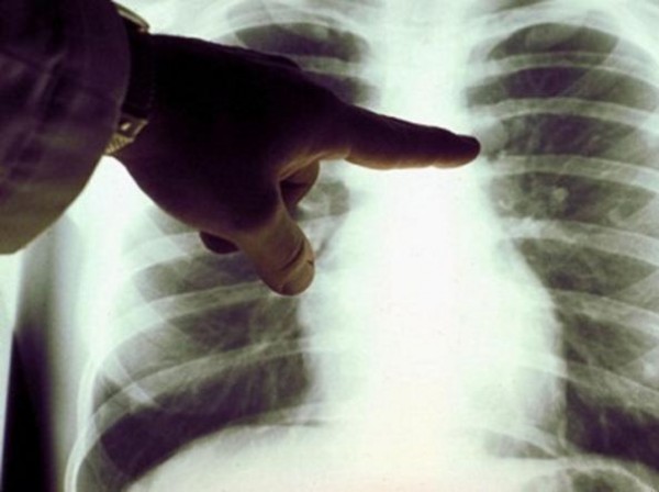 Tumore del polmone, test per diagnosi più precise e terapie mirate