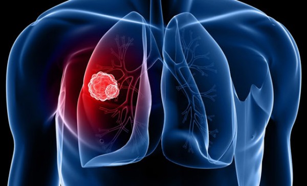 Tumore del polmone: i due volti di hMENA