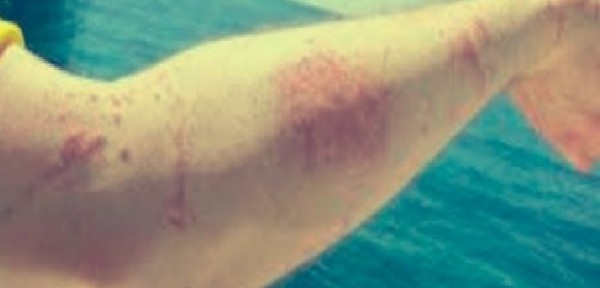 Tornano le meduse in basso Adriatico: morsi sui bagnanti soccorsi dai bagnini